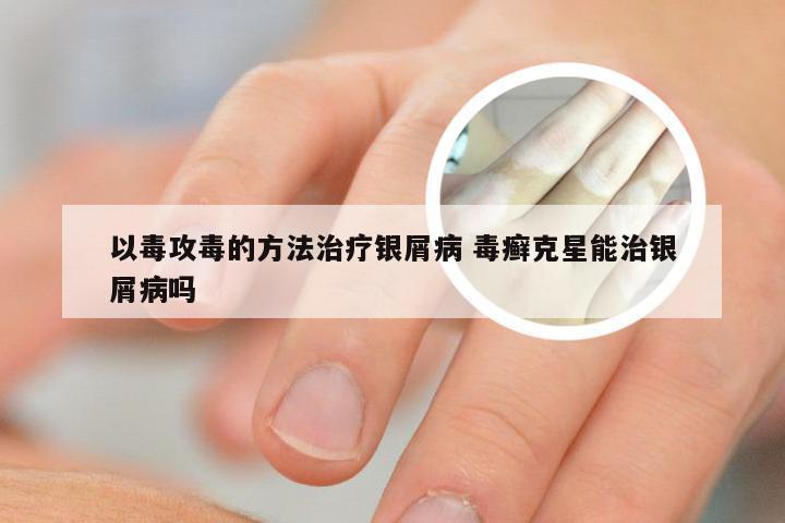 以毒攻毒的方法治疗银屑病 毒癣克星能治银屑病吗