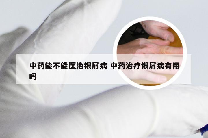 中药能不能医治银屑病 中药治疗银屑病有用吗