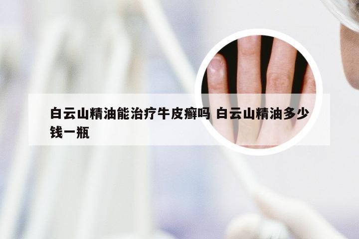 白云山精油能治疗牛皮癣吗 白云山精油多少钱一瓶