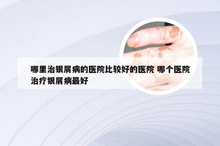 哪里治银屑病的医院比较好的医院 哪个医院治疗银屑病最好