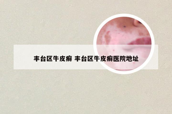 丰台区牛皮癣 丰台区牛皮癣医院地址