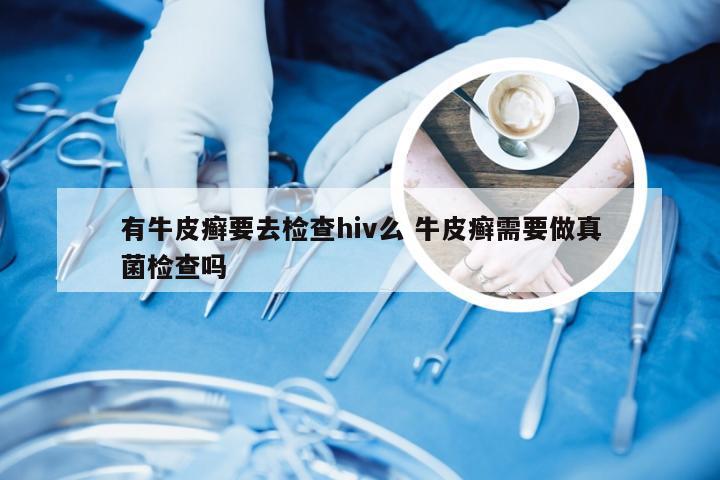 有牛皮癣要去检查hiv么 牛皮癣需要做真菌检查吗