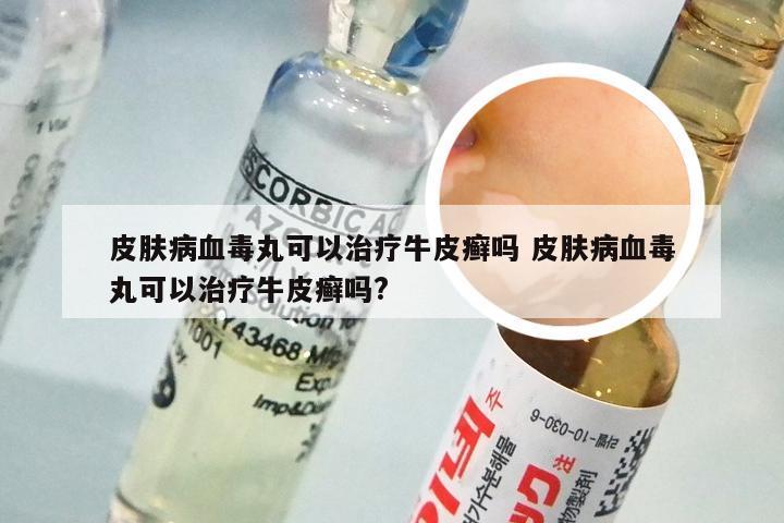 皮肤病血毒丸可以治疗牛皮癣吗 皮肤病血毒丸可以治疗牛皮癣吗?