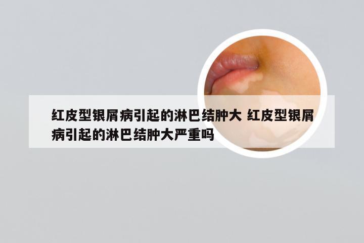 红皮型银屑病引起的淋巴结肿大 红皮型银屑病引起的淋巴结肿大严重吗