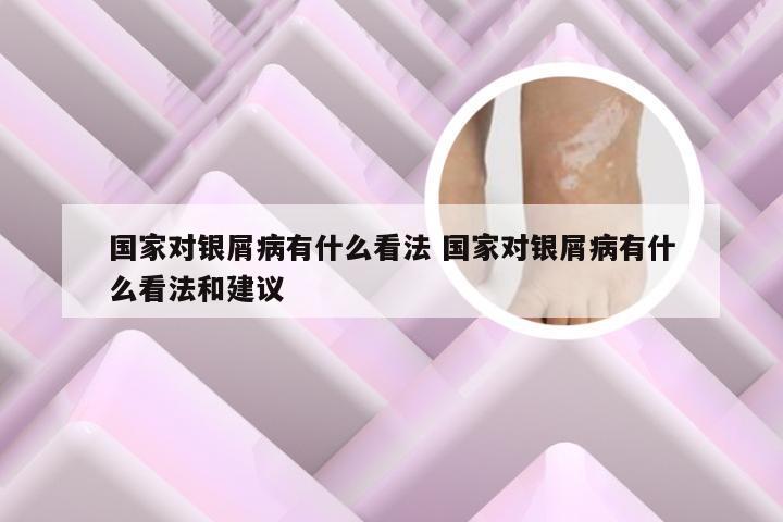 国家对银屑病有什么看法 国家对银屑病有什么看法和建议