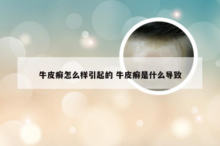 牛皮癣怎么样引起的 牛皮癣是什么导致