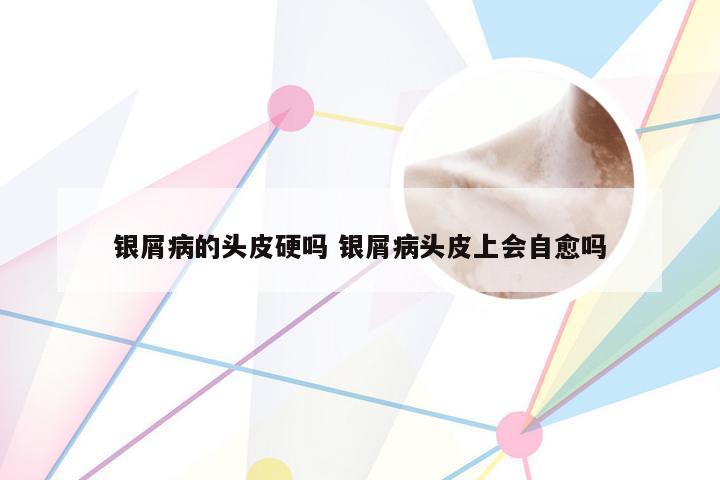 银屑病的头皮硬吗 银屑病头皮上会自愈吗