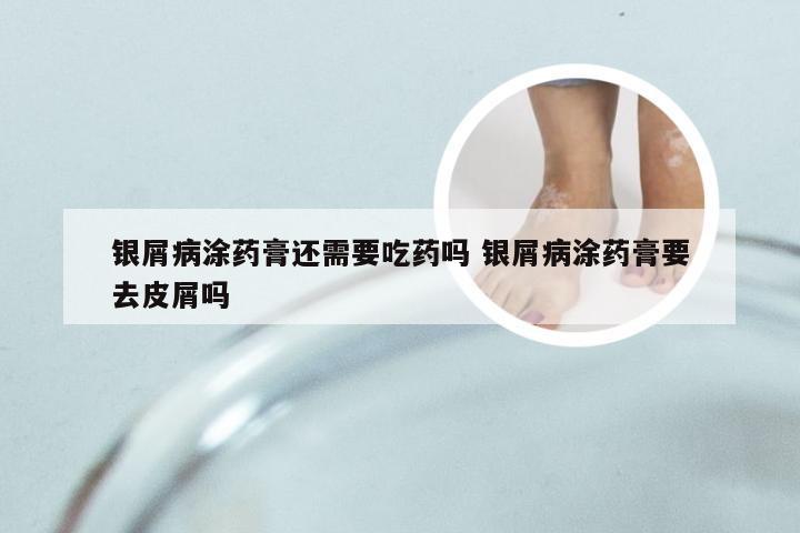 银屑病涂药膏还需要吃药吗 银屑病涂药膏要去皮屑吗