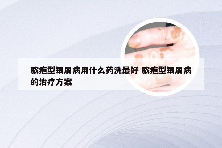 脓疱型银屑病用什么药洗最好 脓疱型银屑病的治疗方案