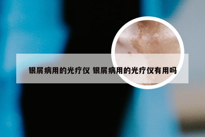 银屑病用的光疗仪 银屑病用的光疗仪有用吗