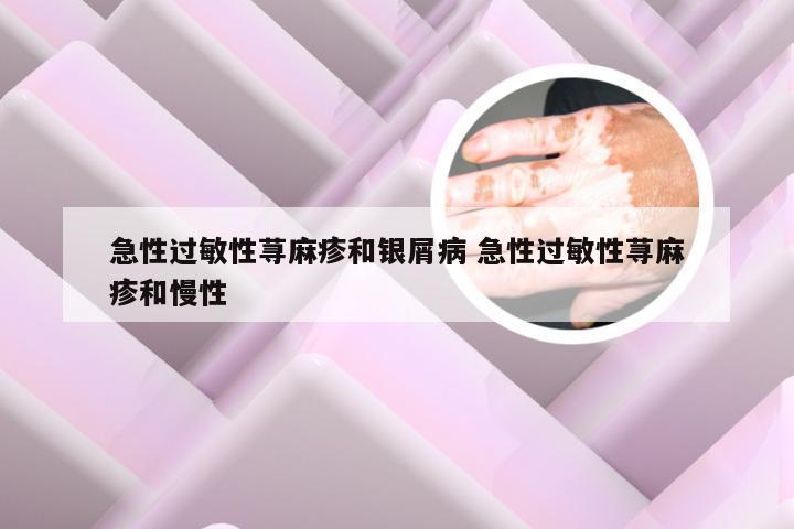 急性过敏性荨麻疹和银屑病 急性过敏性荨麻疹和慢性