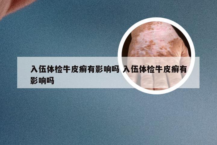 入伍体检牛皮癣有影响吗 入伍体检牛皮癣有影响吗