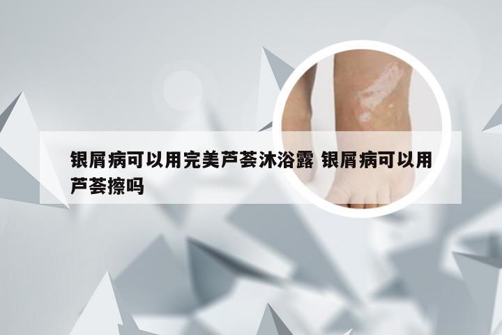 银屑病可以用完美芦荟沐浴露 银屑病可以用芦荟擦吗