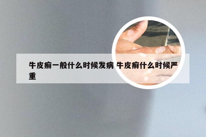牛皮癣一般什么时候发病 牛皮癣什么时候严重