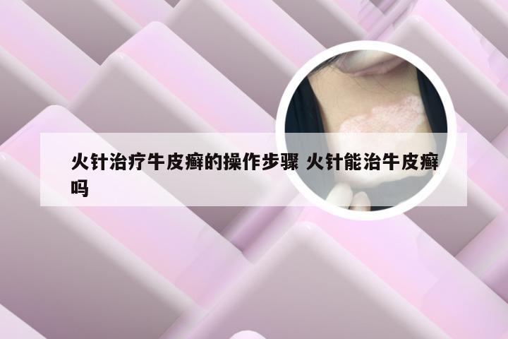 火针治疗牛皮癣的操作步骤 火针能治牛皮癣吗
