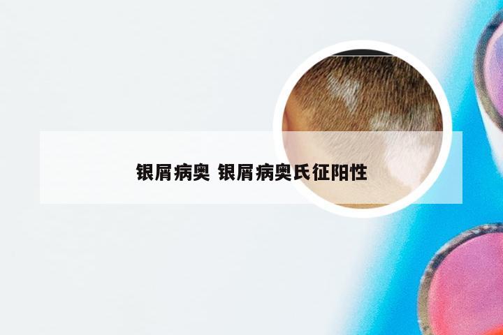 银屑病奥 银屑病奥氏征阳性