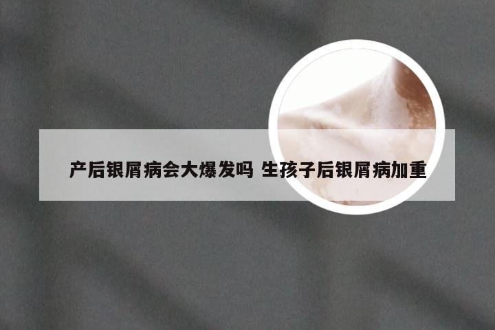 产后银屑病会大爆发吗 生孩子后银屑病加重