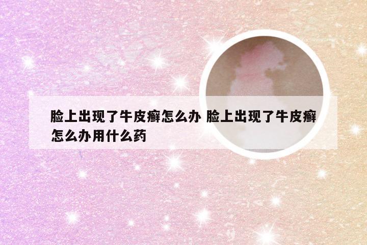脸上出现了牛皮癣怎么办 脸上出现了牛皮癣怎么办用什么药