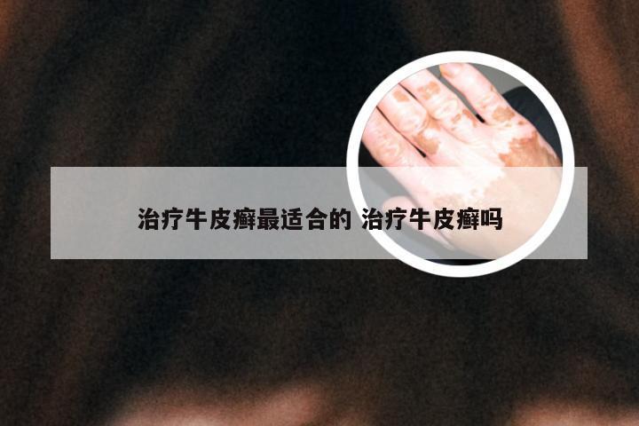 治疗牛皮癣最适合的 治疗牛皮癣吗