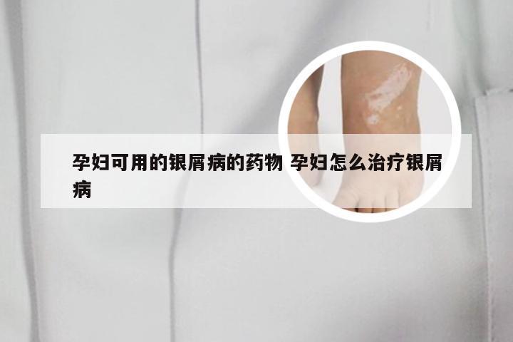 孕妇可用的银屑病的药物 孕妇怎么治疗银屑病