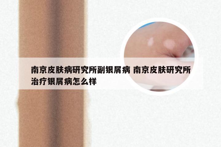 南京皮肤病研究所副银屑病 南京皮肤研究所治疗银屑病怎么样