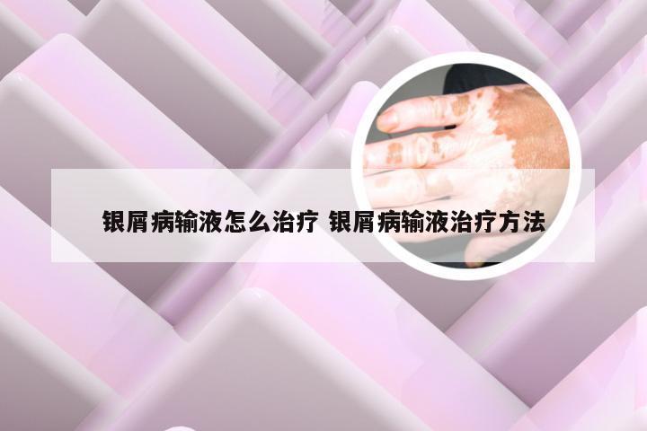 银屑病输液怎么治疗 银屑病输液治疗方法