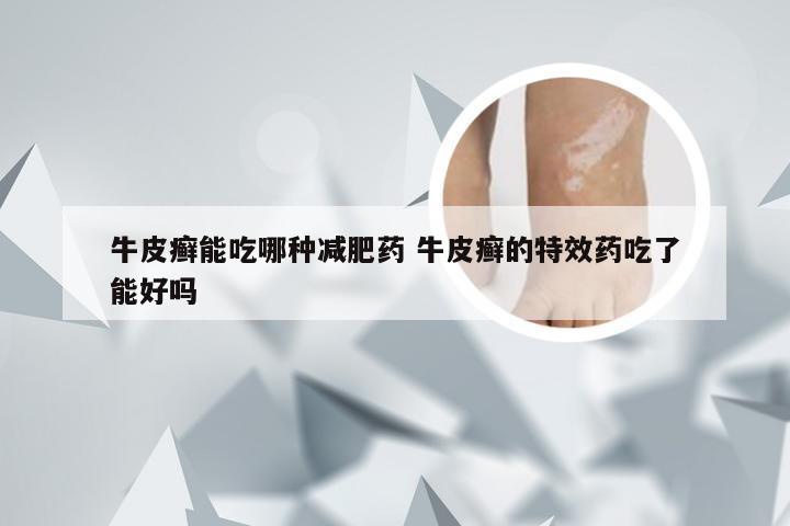 牛皮癣能吃哪种减肥药 牛皮癣的特效药吃了能好吗