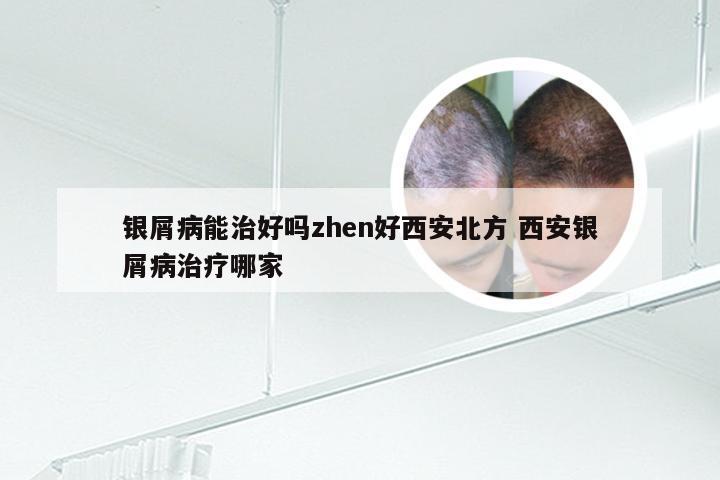 银屑病能治好吗zhen好西安北方 西安银屑病治疗哪家