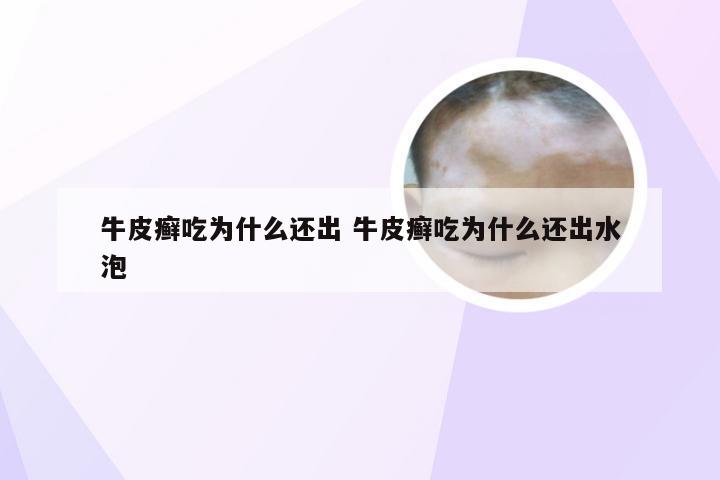牛皮癣吃为什么还出 牛皮癣吃为什么还出水泡