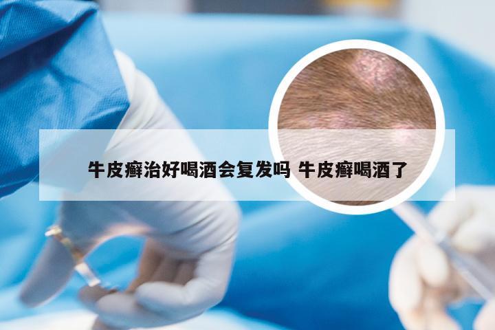 牛皮癣治好喝酒会复发吗 牛皮癣喝酒了
