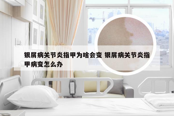 银屑病关节炎指甲为啥会变 银屑病关节炎指甲病变怎么办