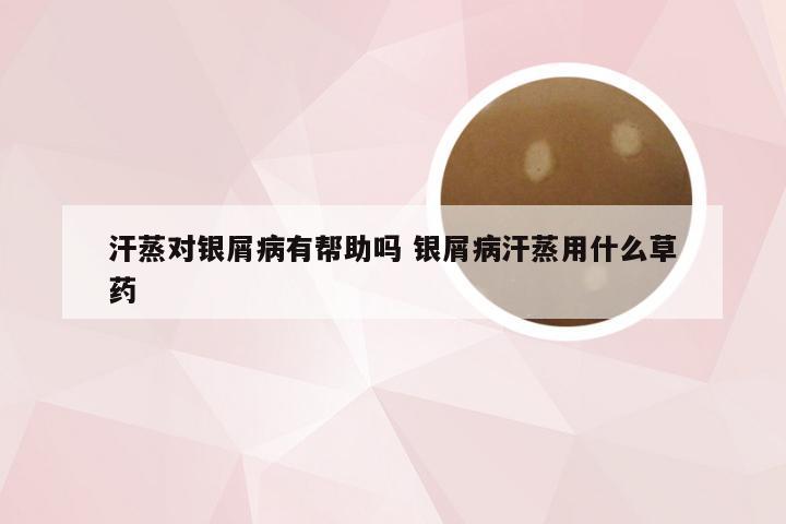 汗蒸对银屑病有帮助吗 银屑病汗蒸用什么草药