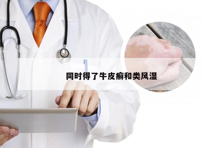 同时得了牛皮癣和类风湿