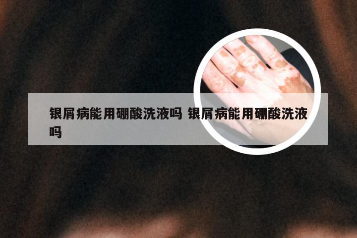 银屑病能用硼酸洗液吗 银屑病能用硼酸洗液吗