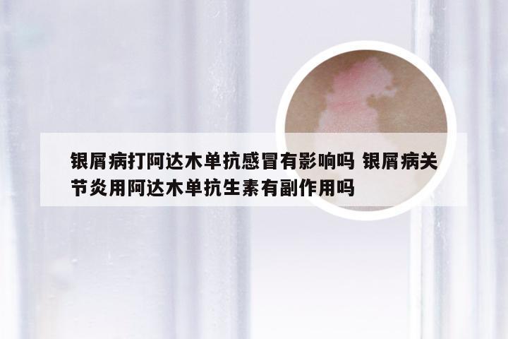 银屑病打阿达木单抗感冒有影响吗 银屑病关节炎用阿达木单抗生素有副作用吗
