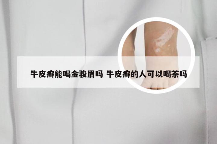 牛皮癣能喝金骏眉吗 牛皮癣的人可以喝茶吗