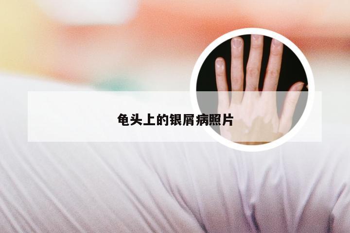 龟头上的银屑病照片