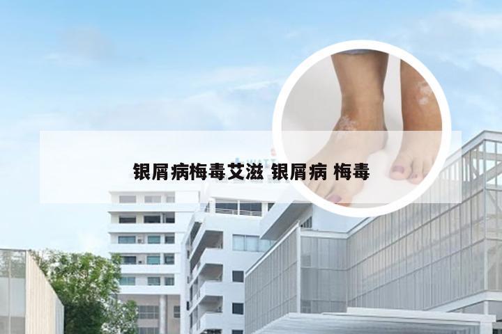 银屑病梅毒艾滋 银屑病 梅毒