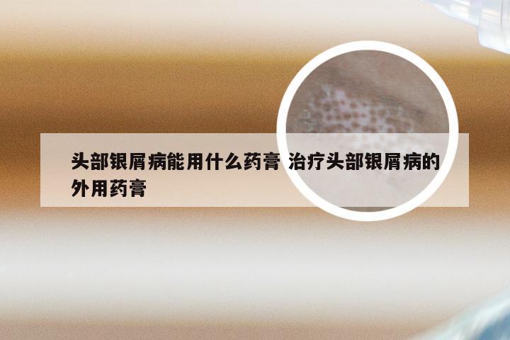 头部银屑病能用什么药膏 治疗头部银屑病的外用药膏