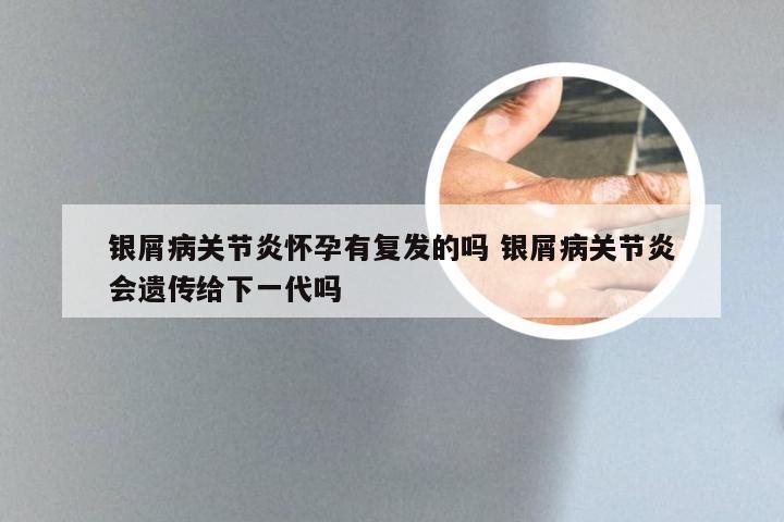 银屑病关节炎怀孕有复发的吗 银屑病关节炎会遗传给下一代吗