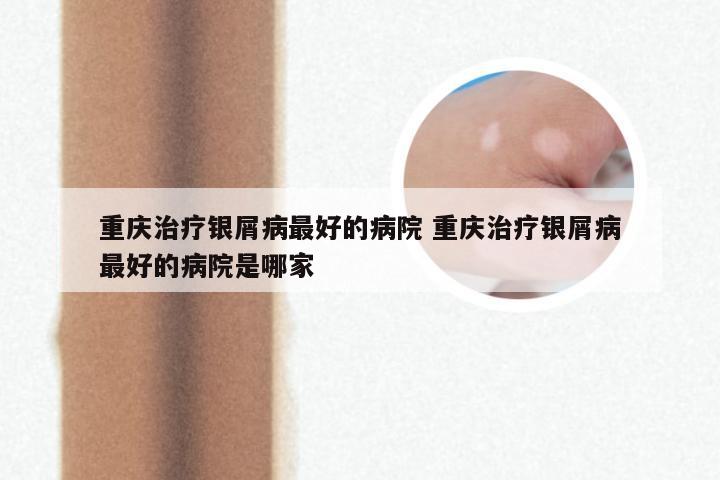 重庆治疗银屑病最好的病院 重庆治疗银屑病最好的病院是哪家