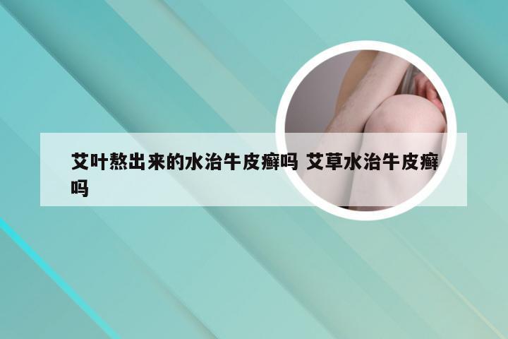 艾叶熬出来的水治牛皮癣吗 艾草水治牛皮癣吗
