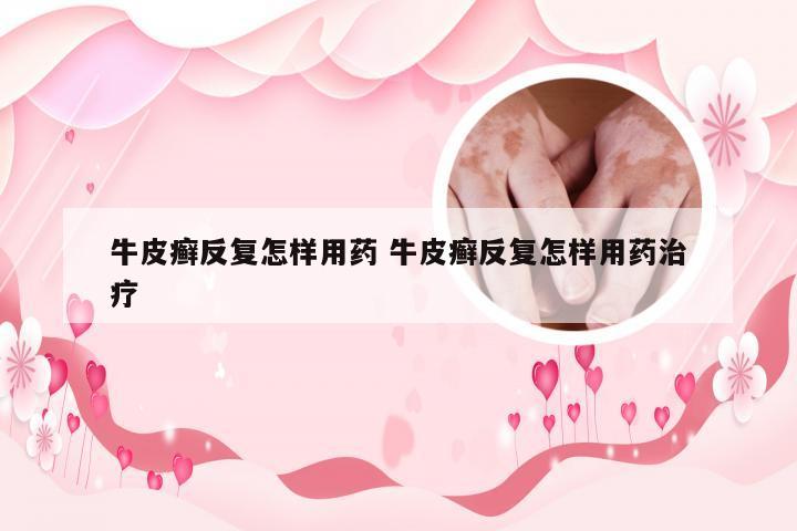 牛皮癣反复怎样用药 牛皮癣反复怎样用药治疗