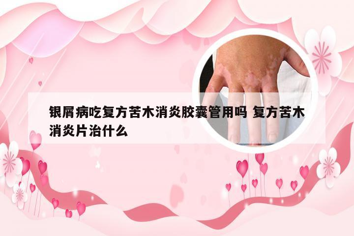 银屑病吃复方苦木消炎胶囊管用吗 复方苦木消炎片治什么