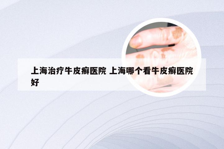 上海治疗牛皮癣医院 上海哪个看牛皮癣医院好