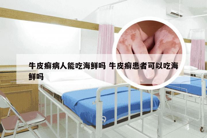 牛皮癣病人能吃海鲜吗 牛皮癣患者可以吃海鲜吗