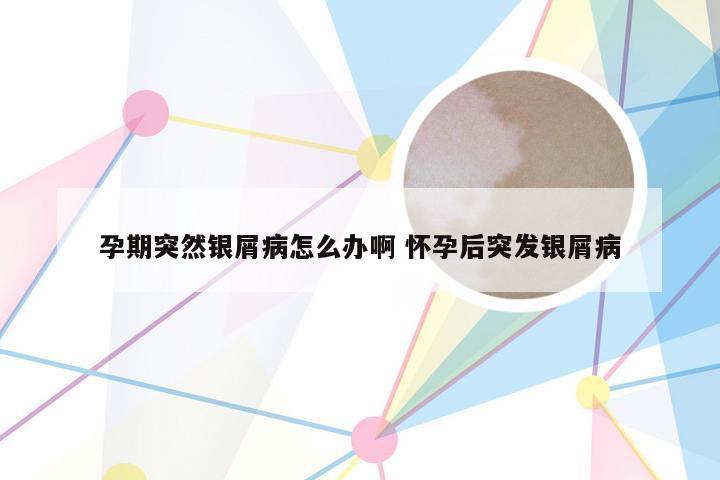 孕期突然银屑病怎么办啊 怀孕后突发银屑病