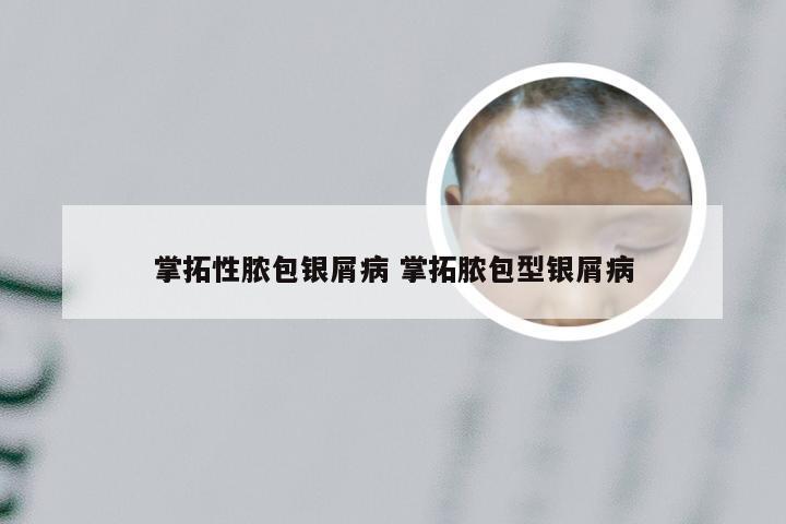 掌拓性脓包银屑病 掌拓脓包型银屑病