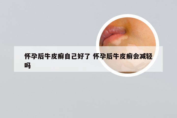 怀孕后牛皮癣自己好了 怀孕后牛皮癣会减轻吗