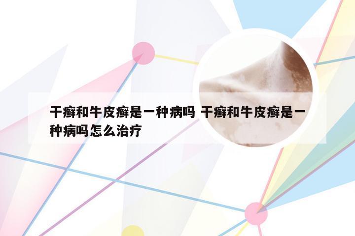 干癣和牛皮癣是一种病吗 干癣和牛皮癣是一种病吗怎么治疗